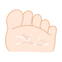 신체부위, 발바닥, 발, 각질, 습진, 무좀, 피부과